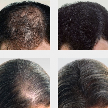 basixx streuhaar test mann