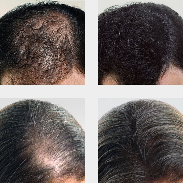 basixx streuhaar test mann